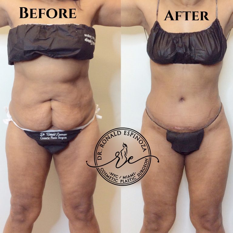 Patient after tummy tuck surgery with Dr. Espinoza