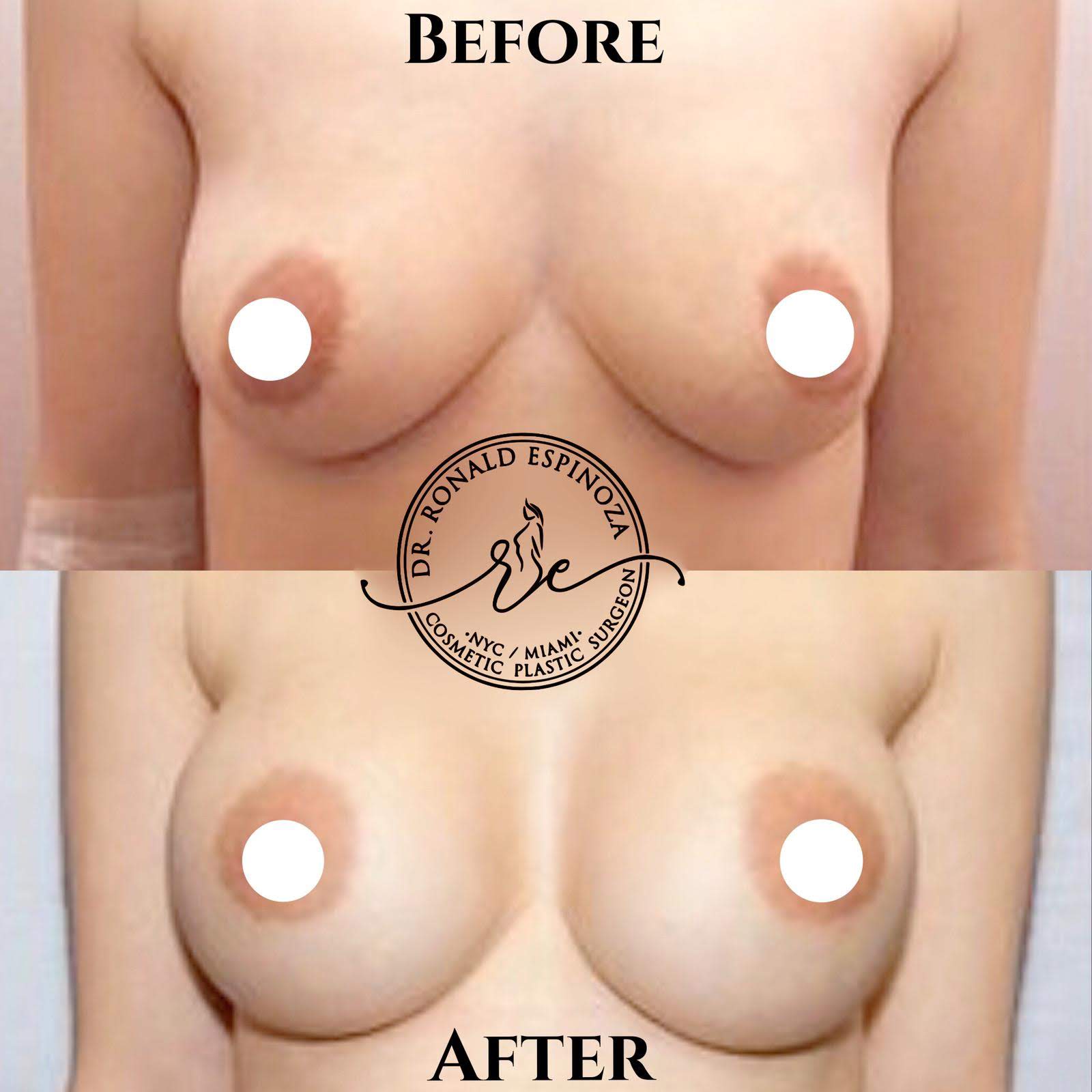 Before & After Breast Implant by Dr. Espinoza