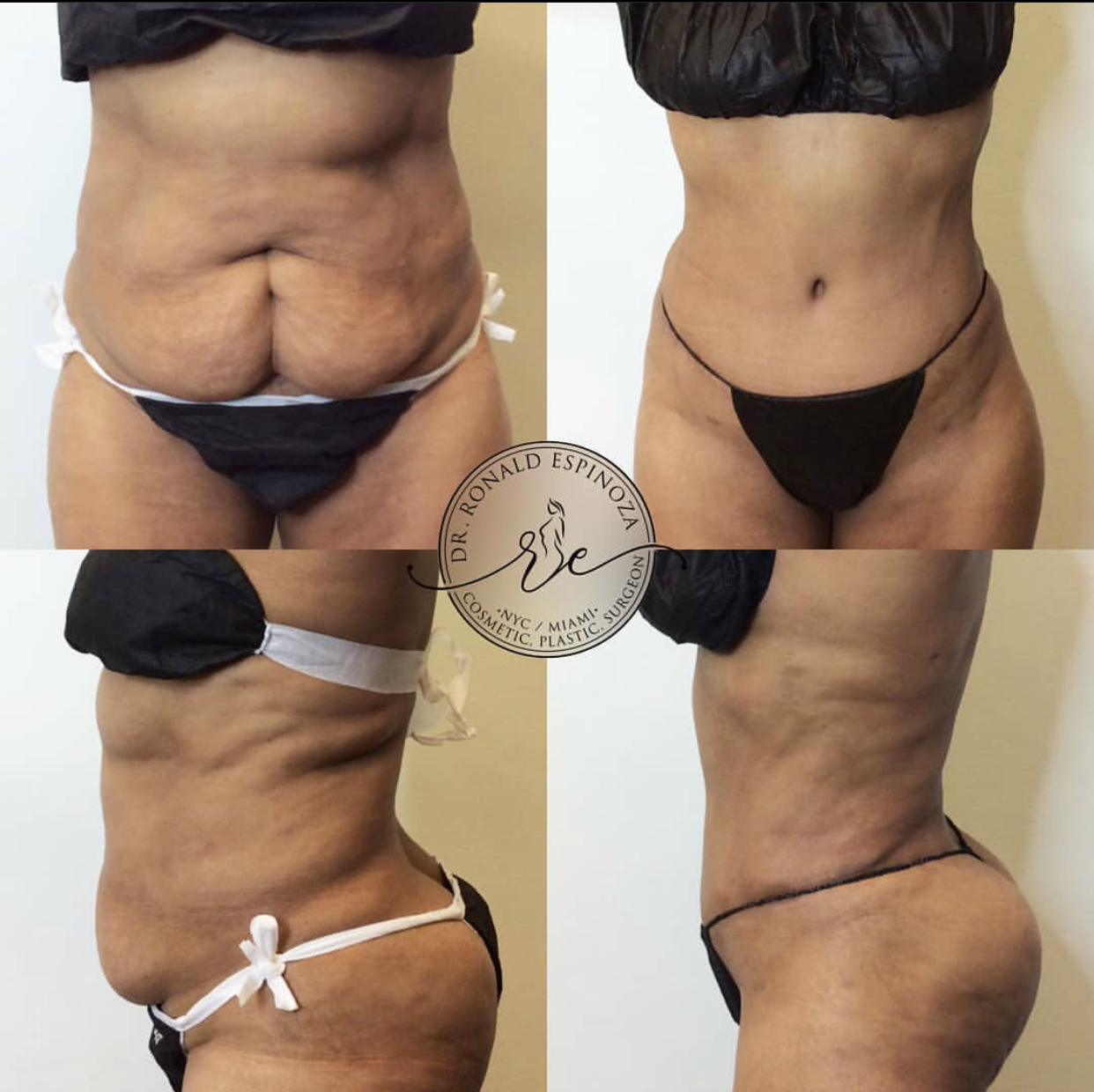 Tummy Tuck Before & After Gallery - Patient 99345301 - Image 1
