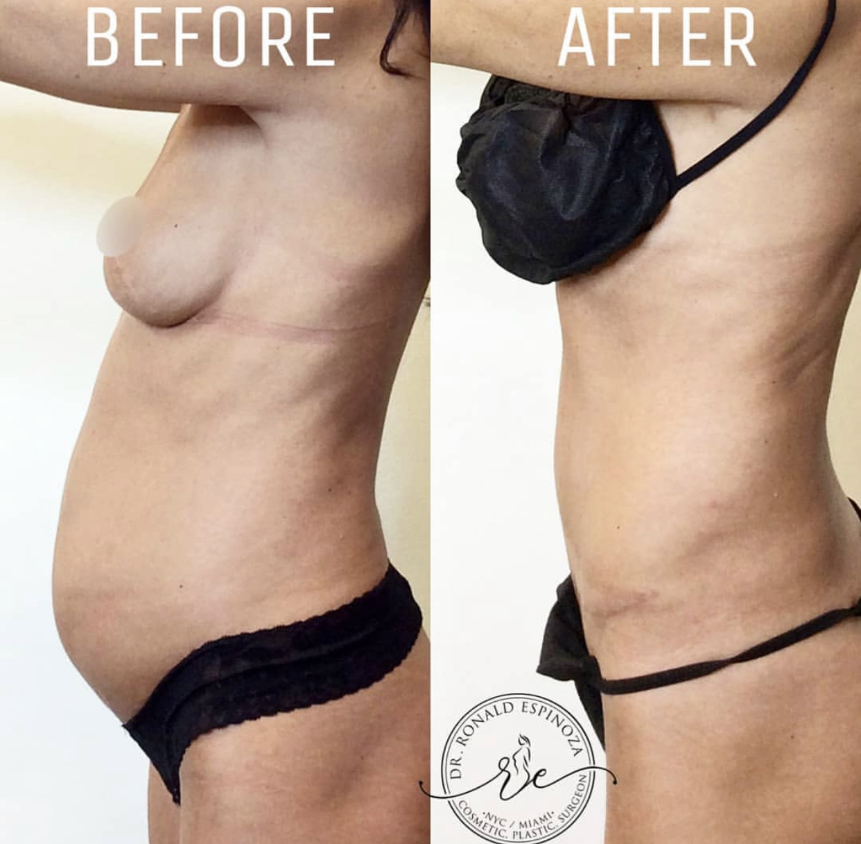 Tummy Tuck Before & After Gallery - Patient 99345350 - Image 1