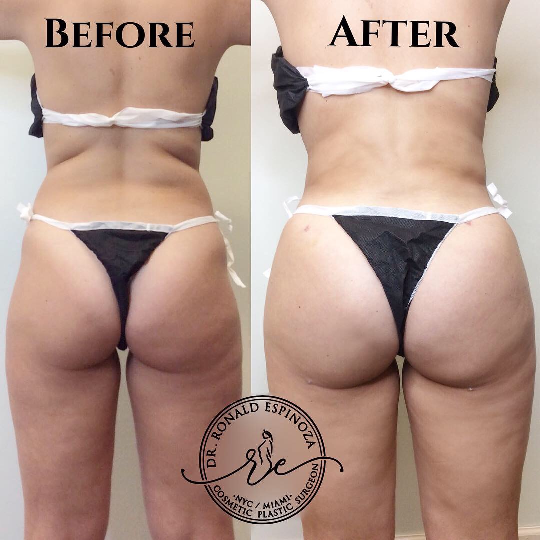 Brazilian Butt Lift Before & After Gallery - Patient 99345759 - Image 1