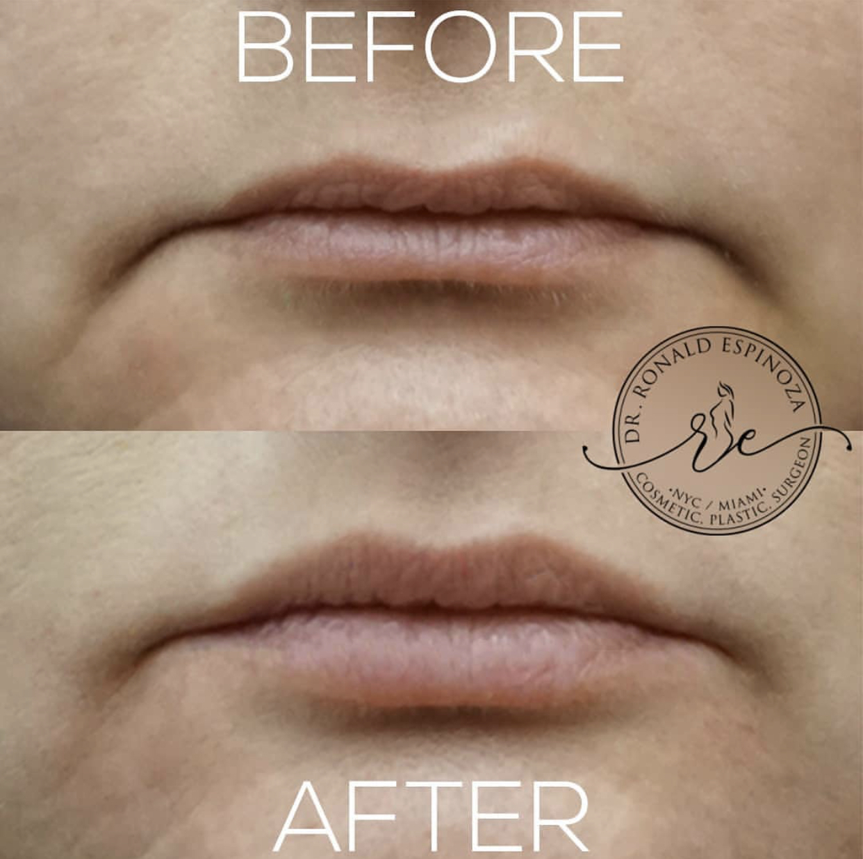 Lip Fillers Before & After Gallery - Patient 99346227 - Image 1