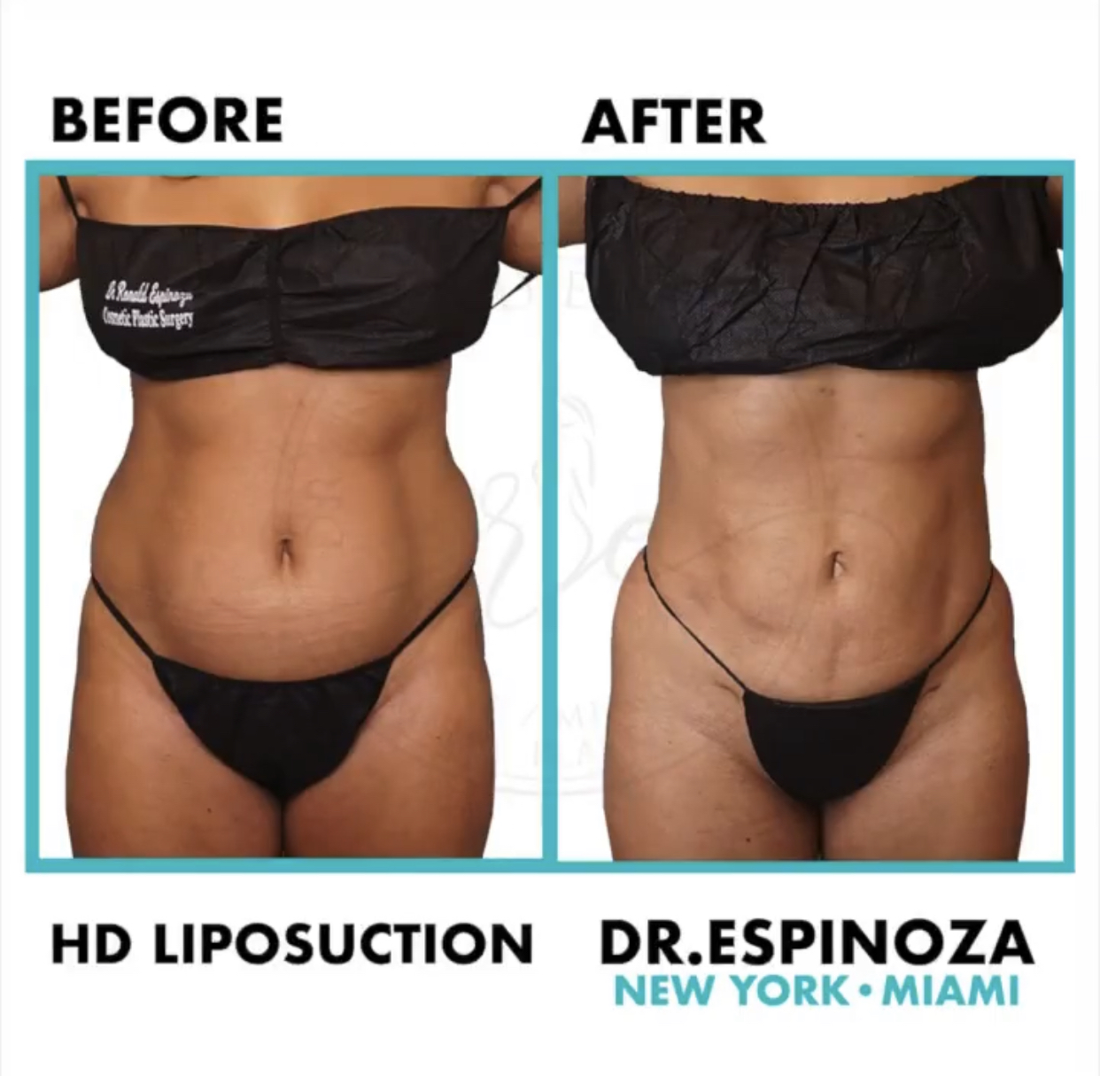 Liposuction Before & After Gallery - Patient 99346236 - Image 1