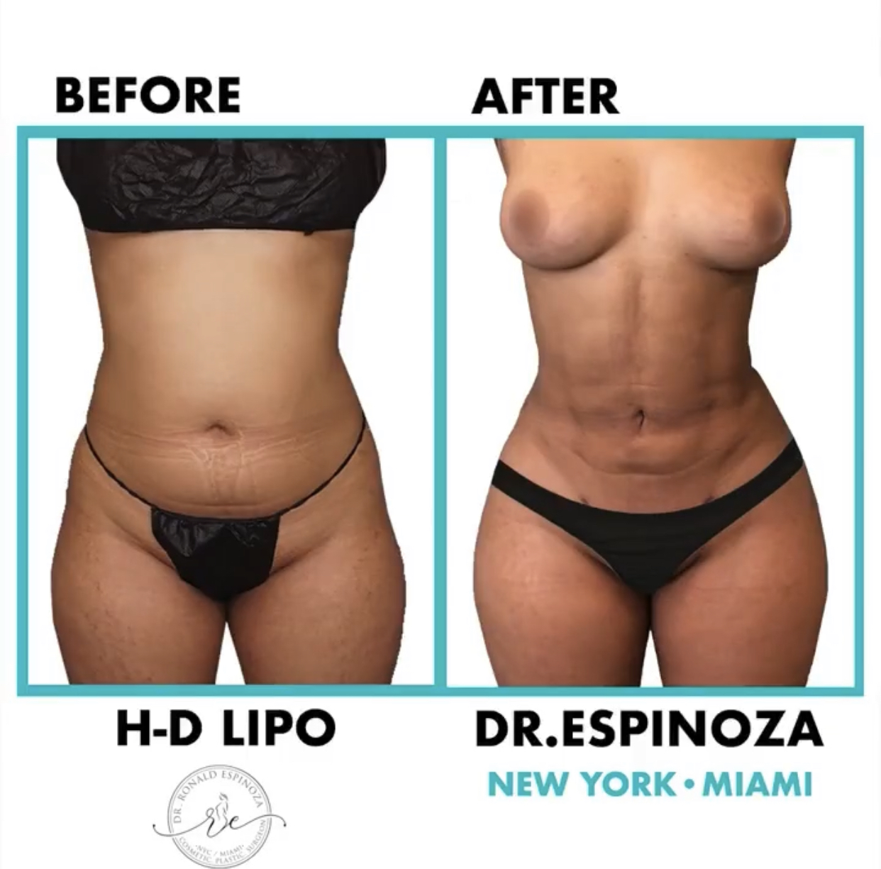 Liposuction Before & After Gallery - Patient 99346248 - Image 1