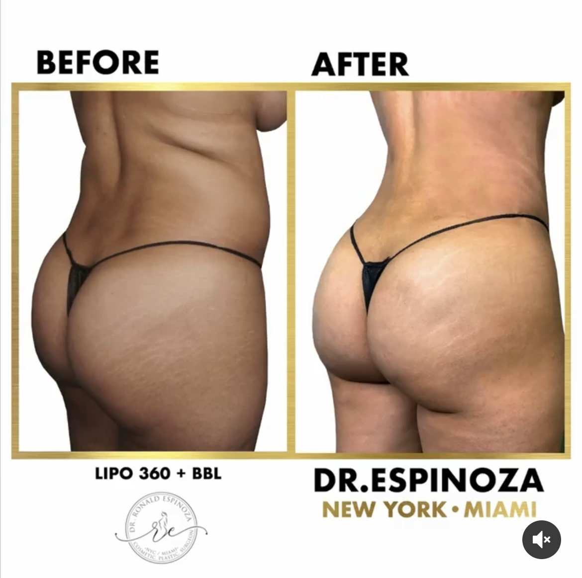 Brazilian Butt Lift Before & After Gallery - Patient 102583359 - Image 1