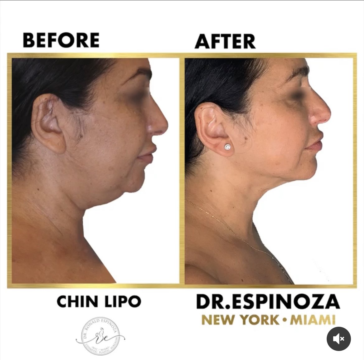 Chin Liposuction Before & After Gallery - Patient 102906284 - Image 1