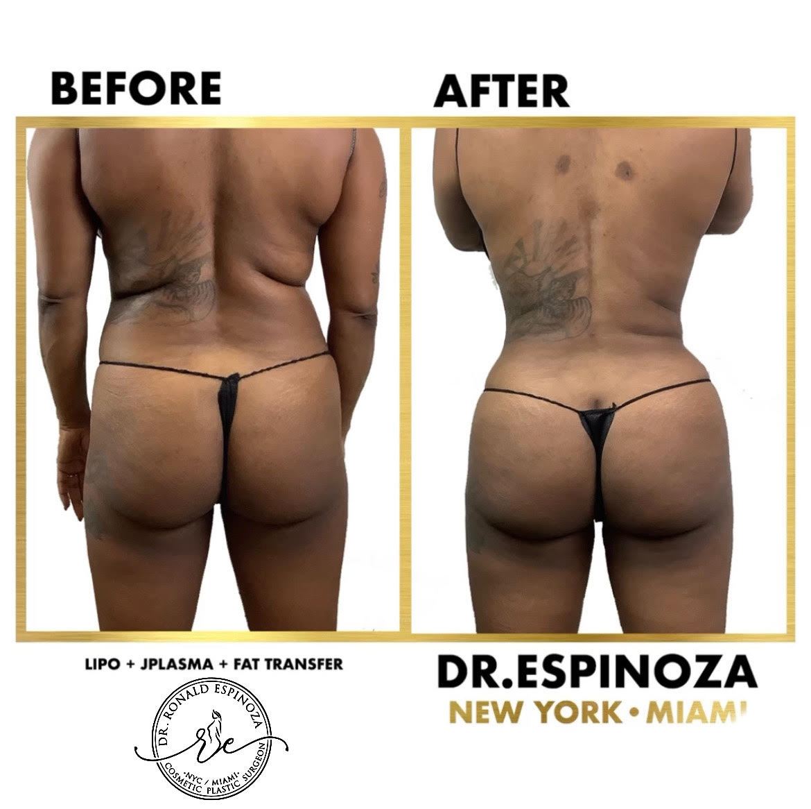 Liposuction Before & After Gallery - Patient 103282238 - Image 1