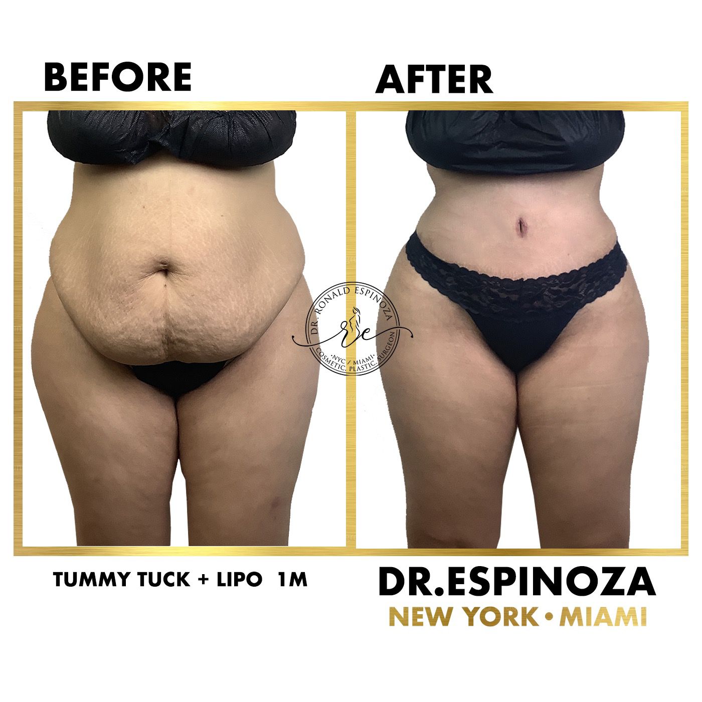 Tummy Tuck Before & After Gallery - Patient 118558429 - Image 1