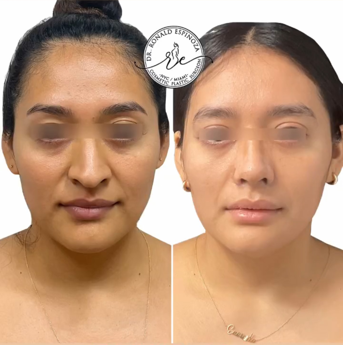Rhinoplasty Before & After Gallery - Patient 150585038 - Image 2